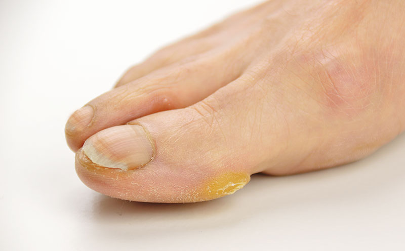 Callus and hyperkeratosis on toe of a female isolated over white background
